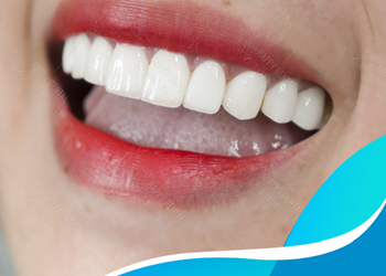 Tẩy trắng răng có bị ê buốt hay không ?