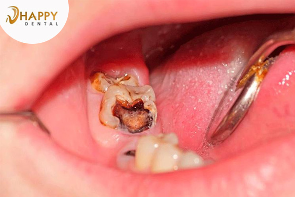 Răng bị sâu lỗ to có nguy hiểm không ? Điều trị răng bị sâu lỗ to như thế nào
