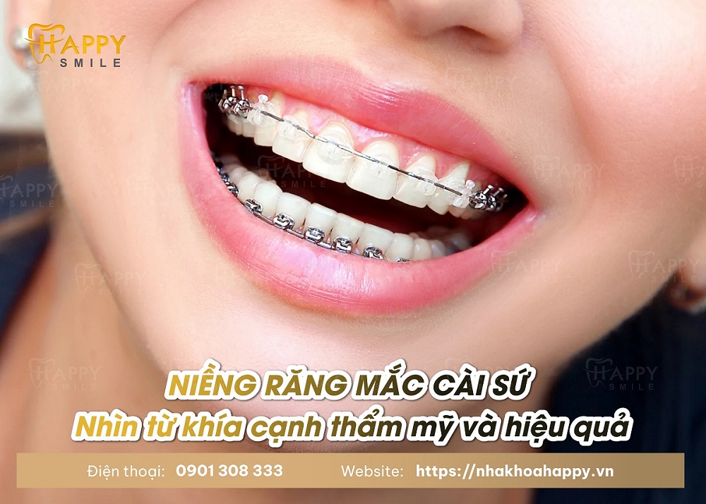 Niềng răng mắc cài sứ có tốt hay không