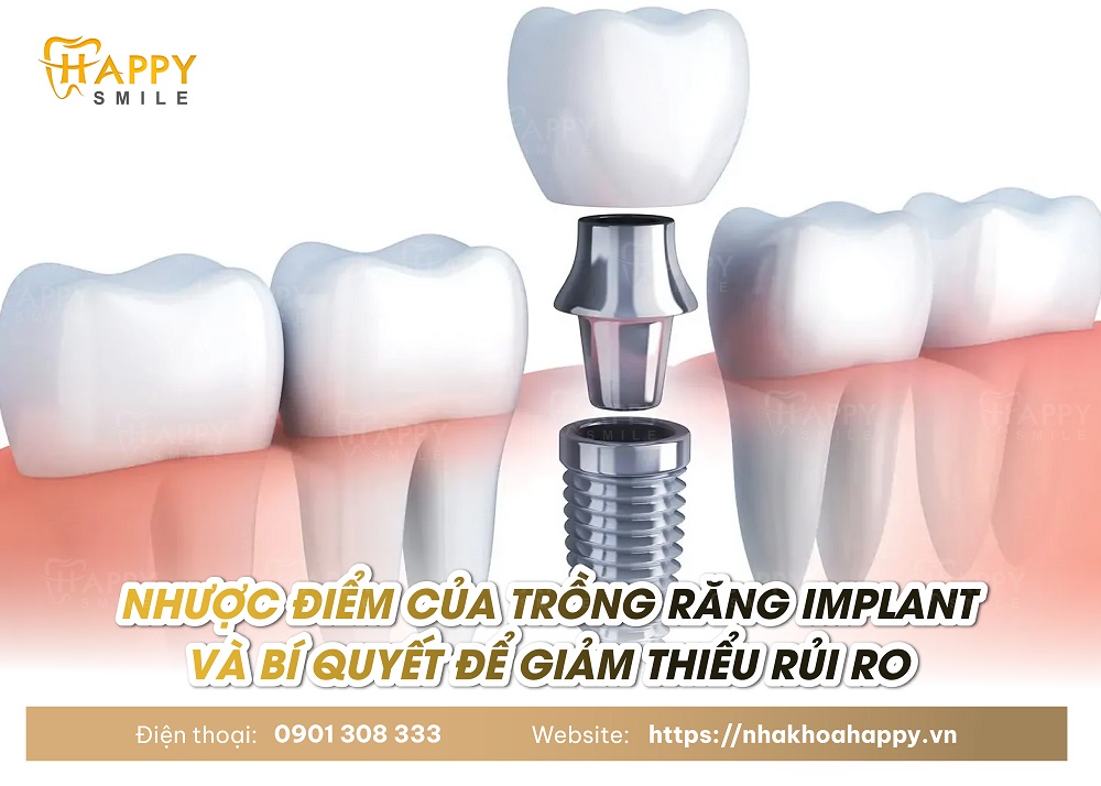 Nhược điểm của trồng răng implant và bí quyết để giảm thiểu rủi ro