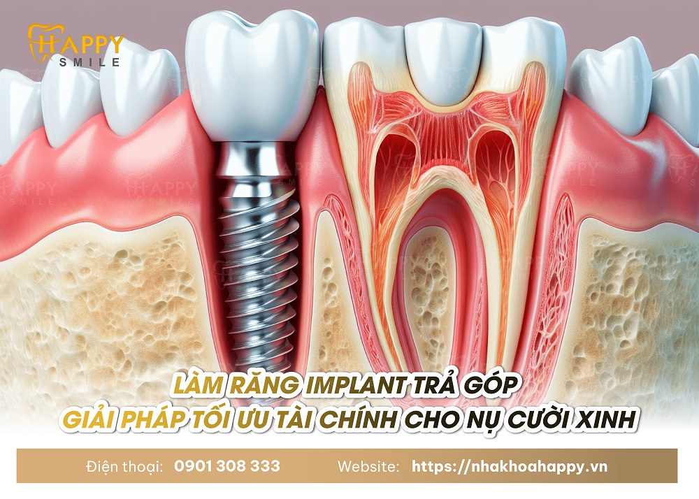 Làm Răng Implant Trả Góp Có Được Hay Không