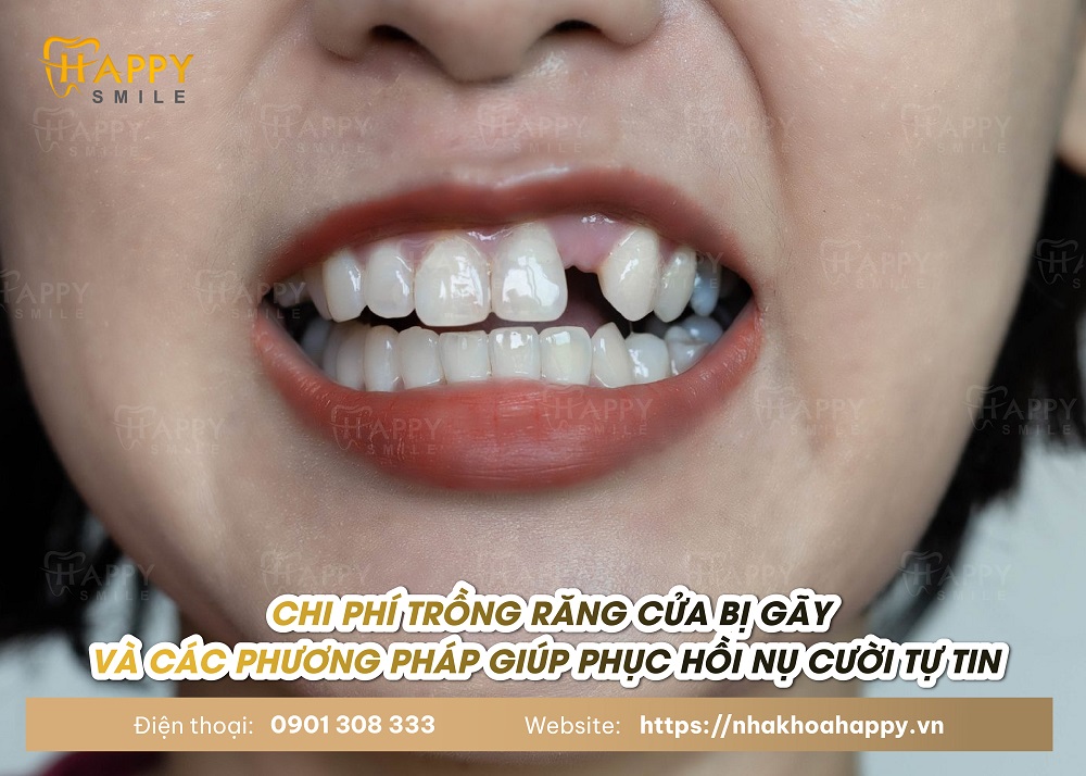 Trồng răng cửa bị gãy và các phương pháp trồng răng lại cửa bị gãy