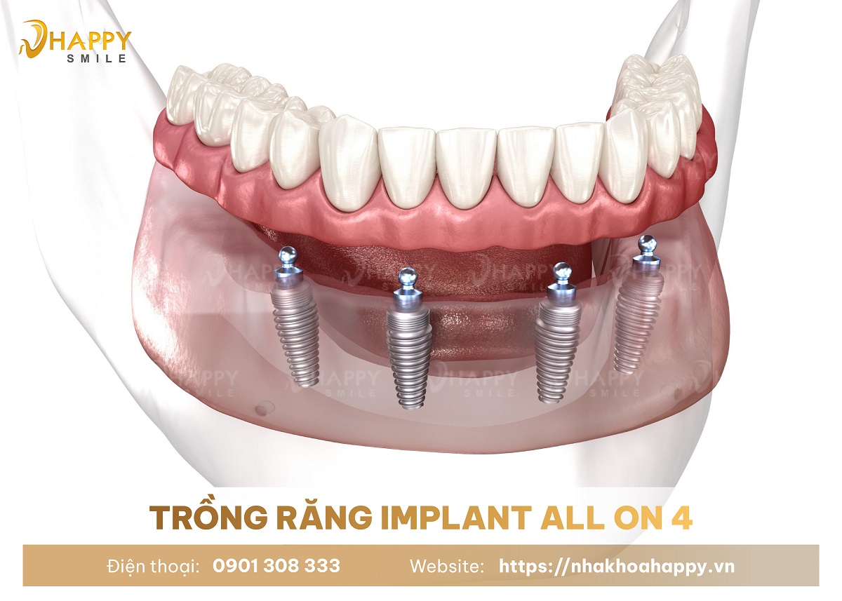 Trồng răng Implant All On 4 giải pháp tối ưu chi phí cho trồng răng nguyên hàm