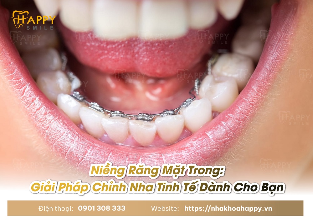 Niềng Răng Mặt Trong Là Giải Pháp Chỉnh Nha Tinh Tế Dành Cho Bạn