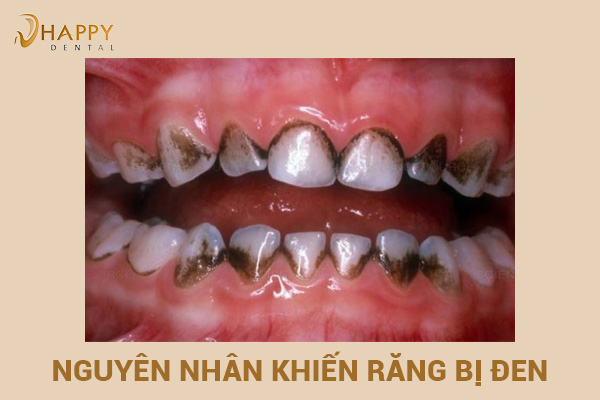 Chân răng bị đen do đâu và cách khắc phục chân răng bị đen nhanh nhất