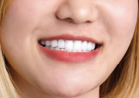 Bảng màu răng sứ Cercon HT và cách chọn màu sứ Cercon HT tự nhiên và đẹp nhất