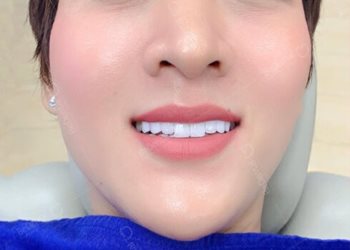 RĂNG SỨ LAVA LÀ GÌ ? RĂNG SỨ LAVA CÓ TỐT KHÔNG ?