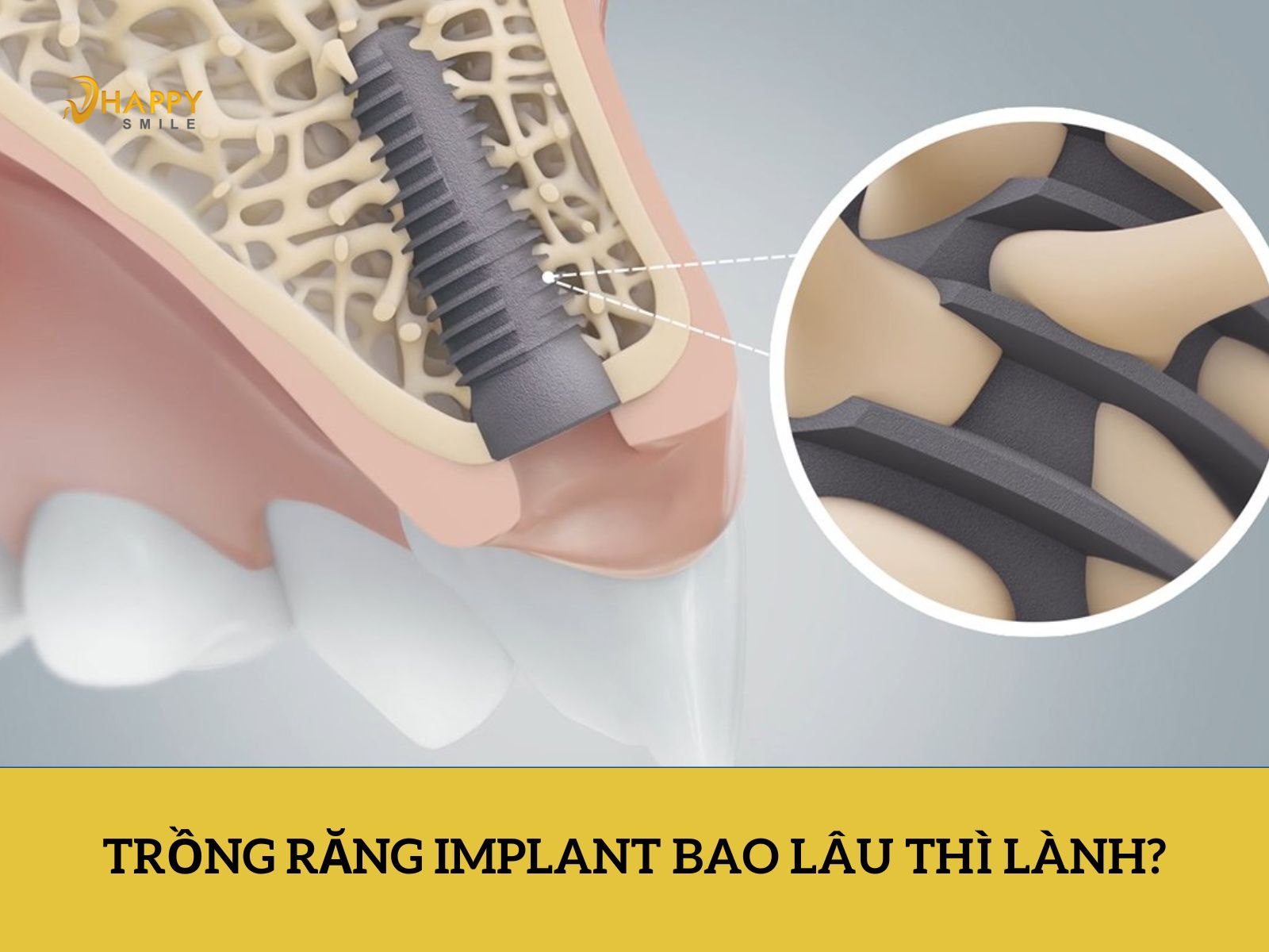 Trồng răng Implant bao lâu thì lành thương