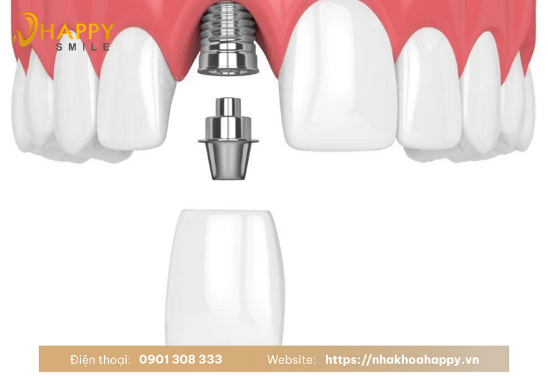 Trồng implant cho răng cửa là giải pháp hiện đại thay thế răng đã mất