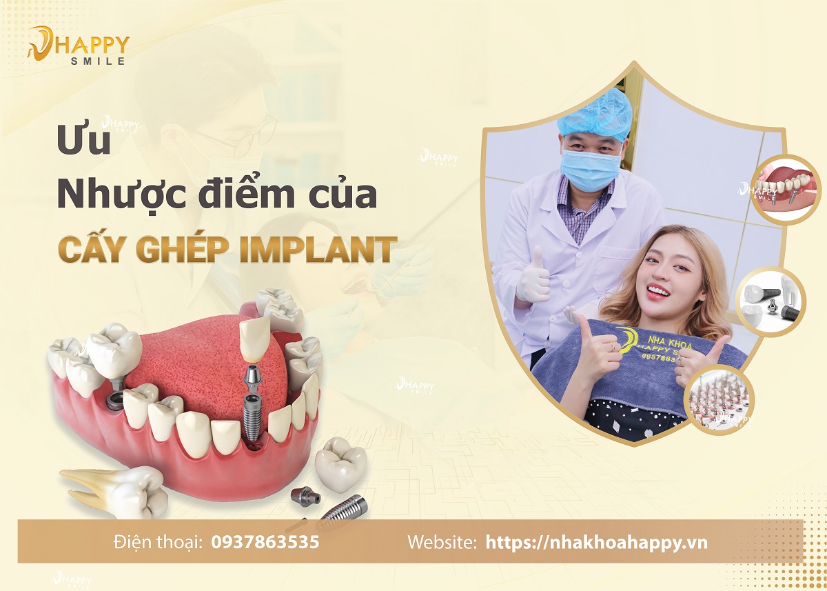 Ưu điểm và nhược điểm của trồng răng Implant