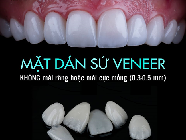 MAT-DAN-SU-VENEER-BAO-NHIEU-TIEN--1-.png