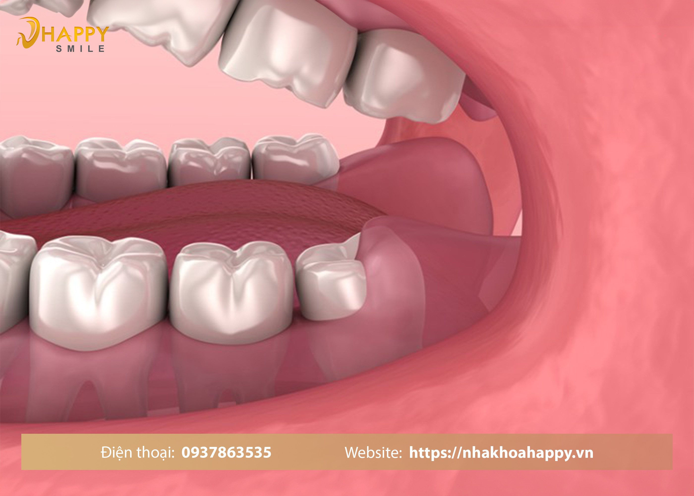 Sưng nướu răng trong cùng hàm dưới nguyên nhân và cách điều trị