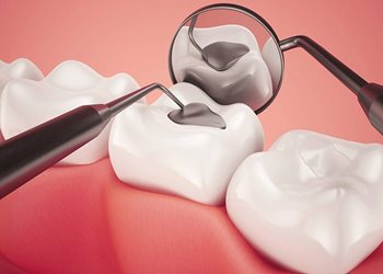 Răng Sâu Lỗ To Có Trám Được Không