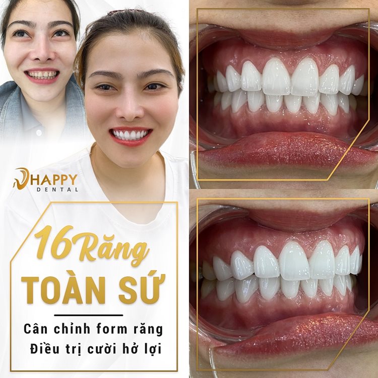 boc-rang-toan-su-deu-dep.jpg