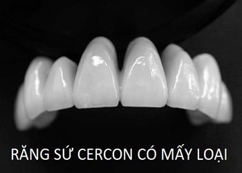 RĂNG TOÀN SỨ CERCON CÓ MẤY LOẠI ? NÊN BỌC SỨ CERCON NÀO TỐT NHẤT