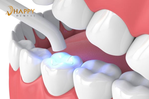 Trám răng thẩm mỹ là gì ? Trám răng sẽ duy trì được bao lâu