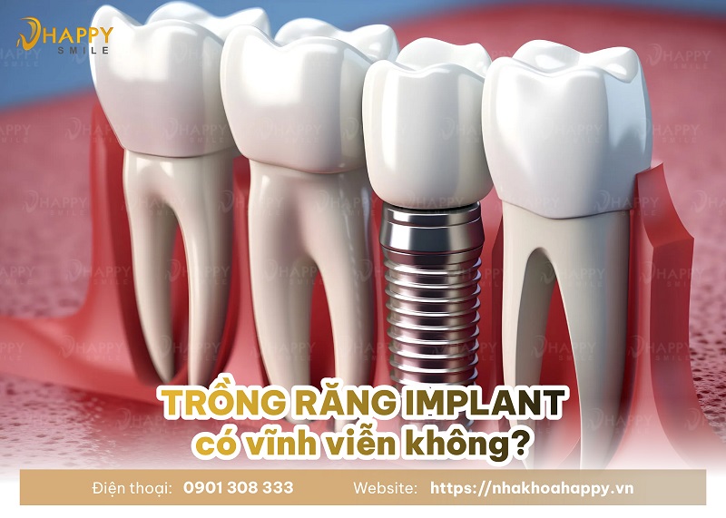 Trồng răng implant có dùng vĩnh viễn không