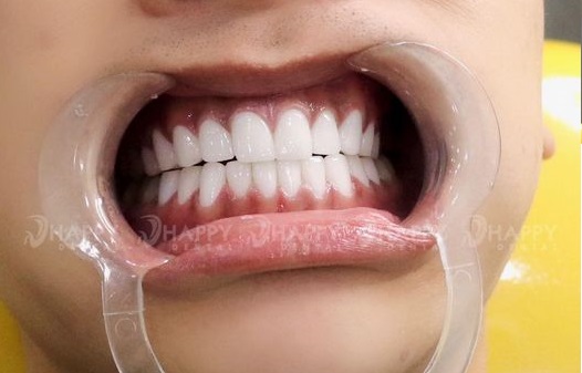 Răng sứ emax của nước nào? Răng sứ emax giá bao nhiêu tiền