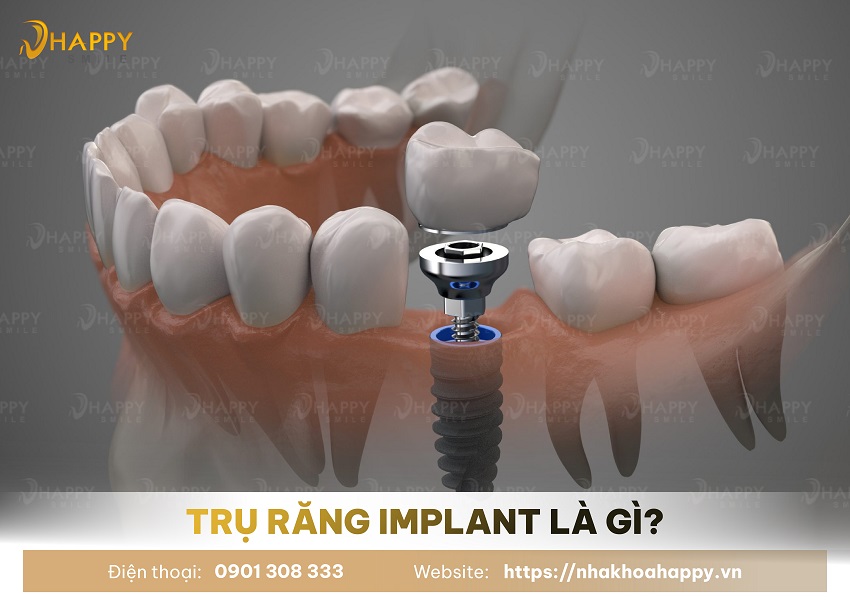 Trụ Răng Implant Là Gì ? Cấu Tạo, Chức Năng Và Lợi Ích Khi Trồng Răng Implant
