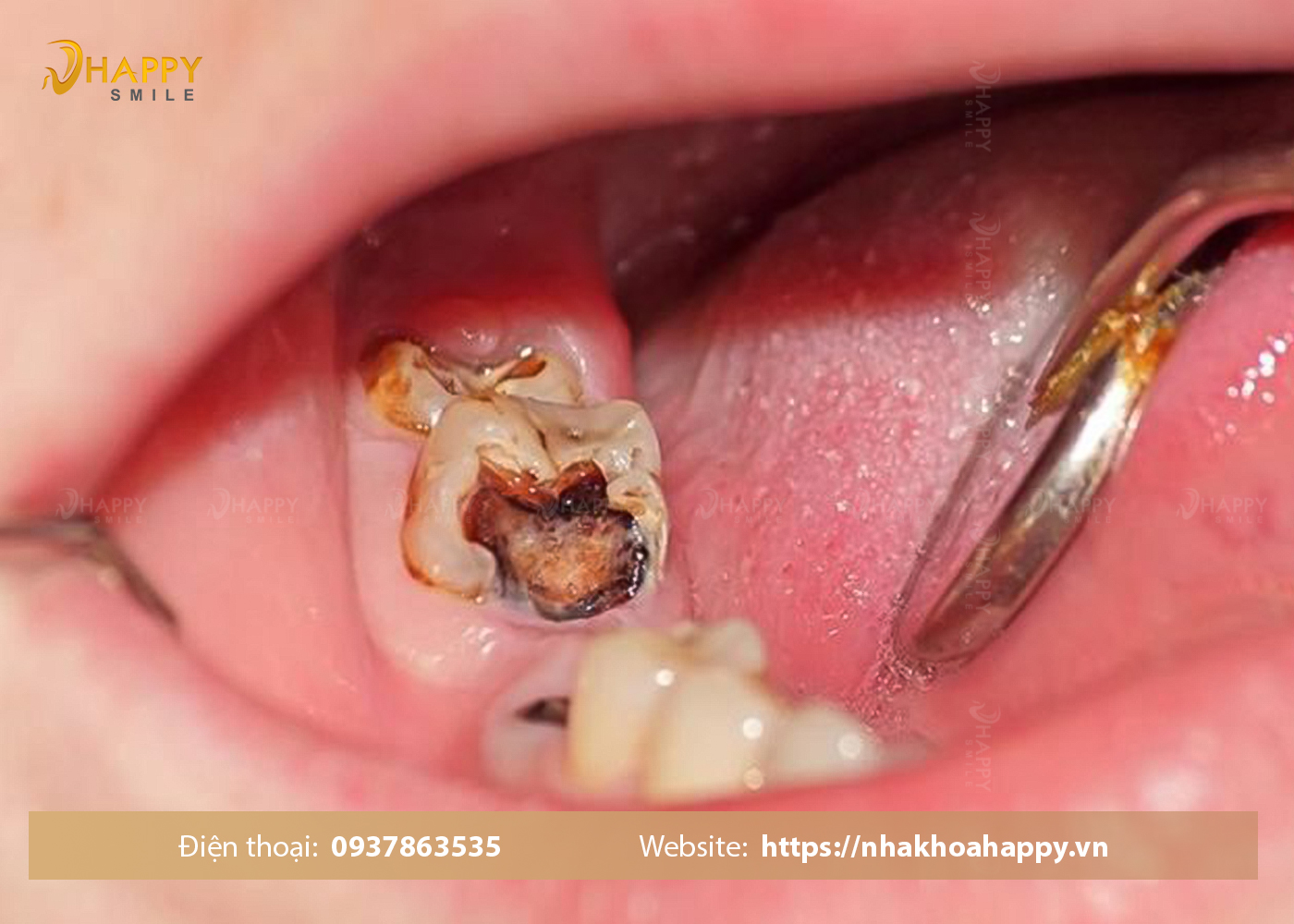 Răng bị sâu lỗ to có nguy hiểm không ? Điều trị răng bị sâu lỗ to như thế nào
