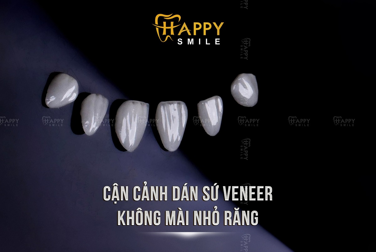 Giá dán sứ Veneer Emax bao nhiêu tiền
