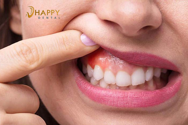 Viêm lợi có mủ nguyên nhân do đâu và cách khắc phục viêm lợi răng có mủ ?