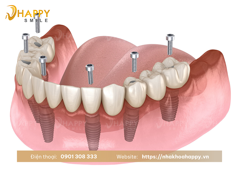 Trồng răng implant toàn hàm giá bao nhiêu tiền