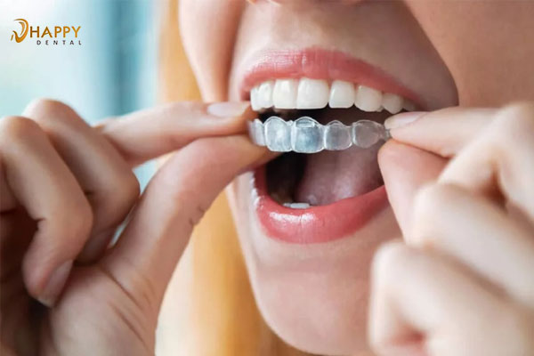 Quy trình niềng răng trong suốt Invisalign diễn ra như thế nào và có đau không