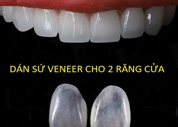 DÁN SỨ VENEER CHO 2 RĂNG CỬA BAO NHIÊU TIỀN - Nha Khoa HAPPY DENTAL - Nha Khoa HAPPY DENTAL