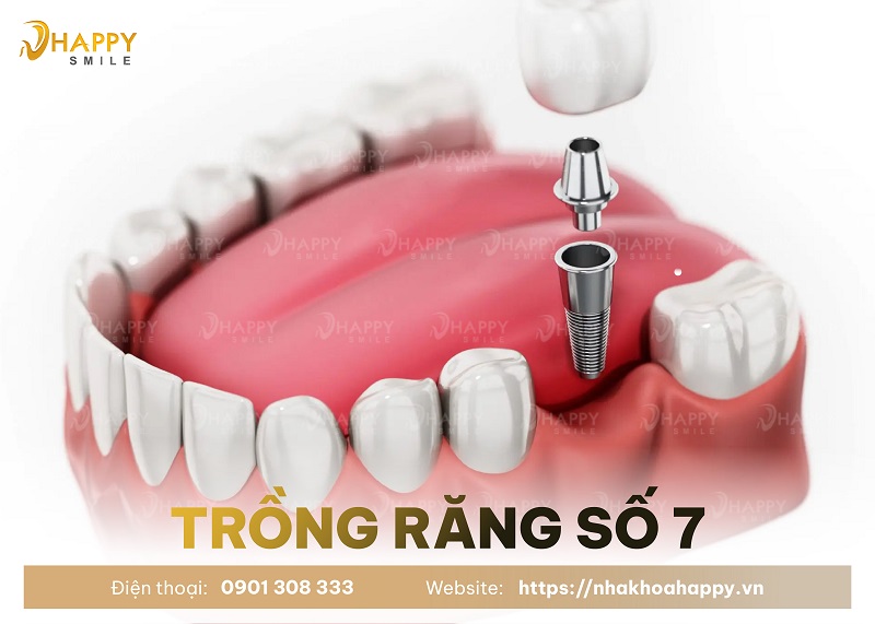 Trồng răng số 7 có được hay không và những điều cần biết