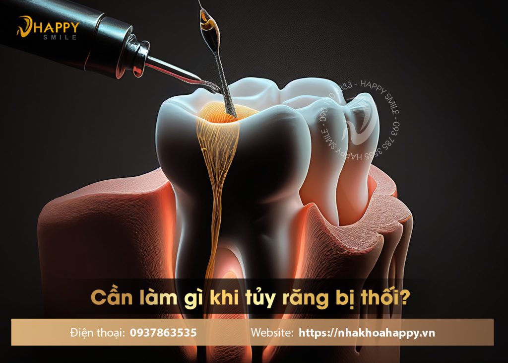 Tủy răng bị thối và các tác hại nguy hiểm đi kèm