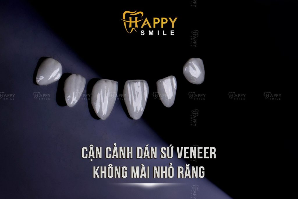 Giá dán sứ Veneer Emax bao nhiêu tiền